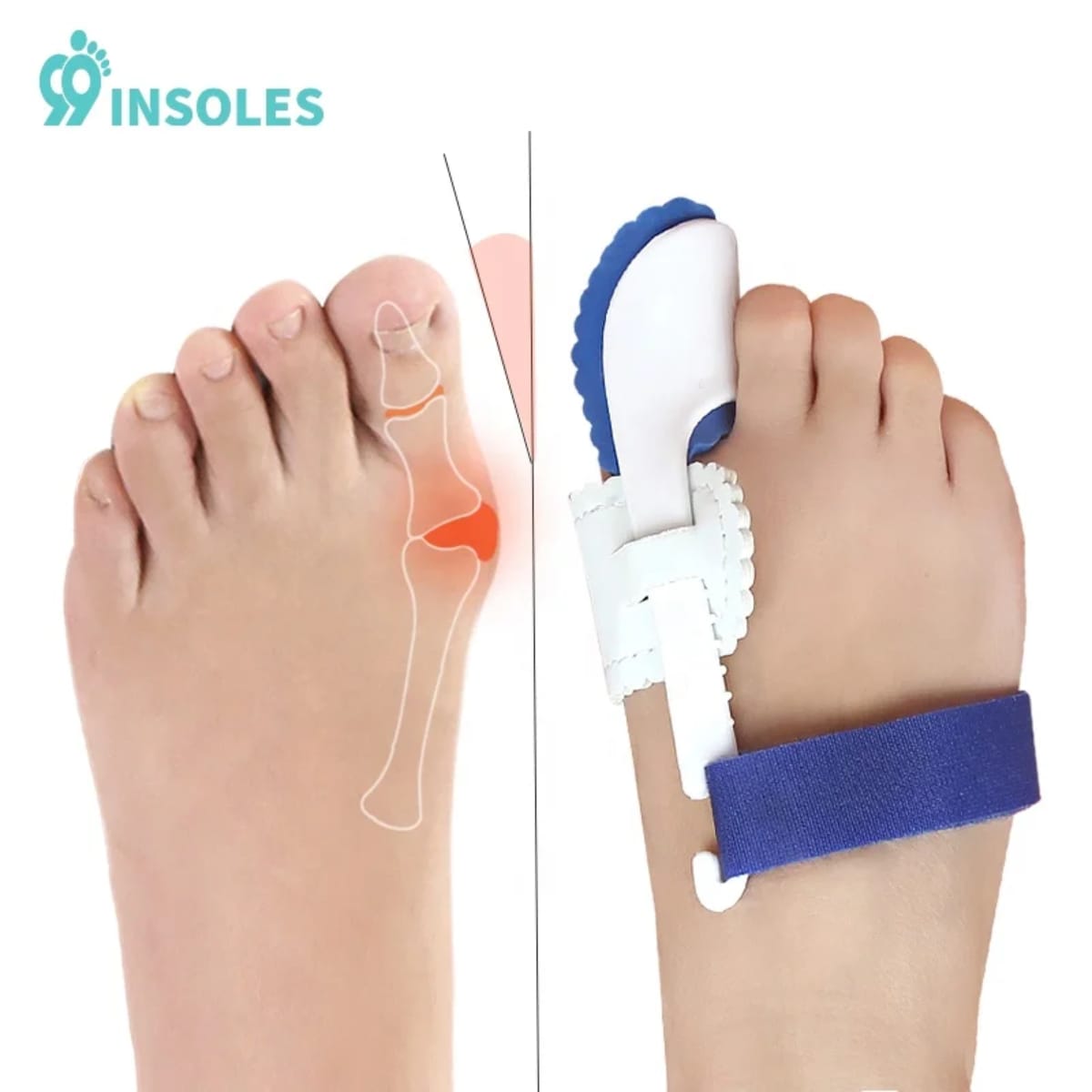 مصحح ابهام القدم مصحح ابهام القدم